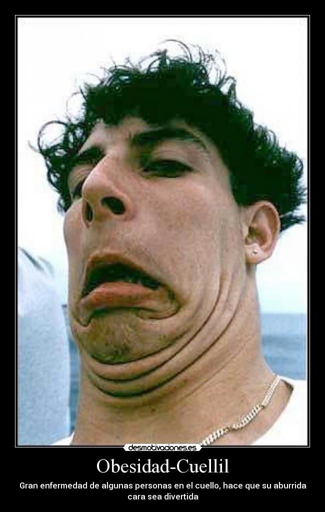 Obesidad-Cuellil - Gran enfermedad de algunas personas en el cuello, hace que su aburrida
cara sea divertida
