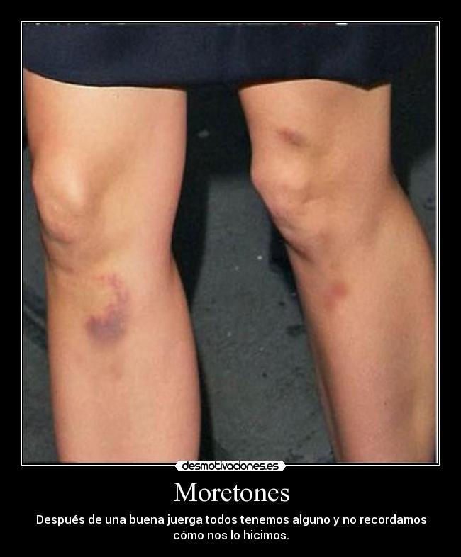 Moretones - 