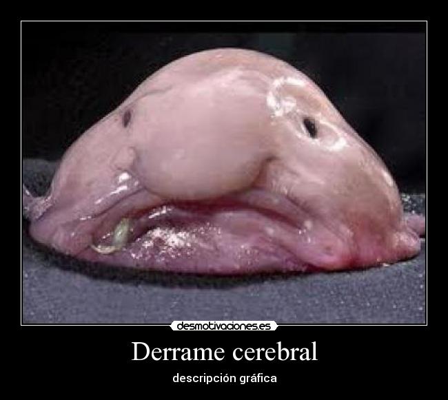 Derrame cerebral - descripción gráfica