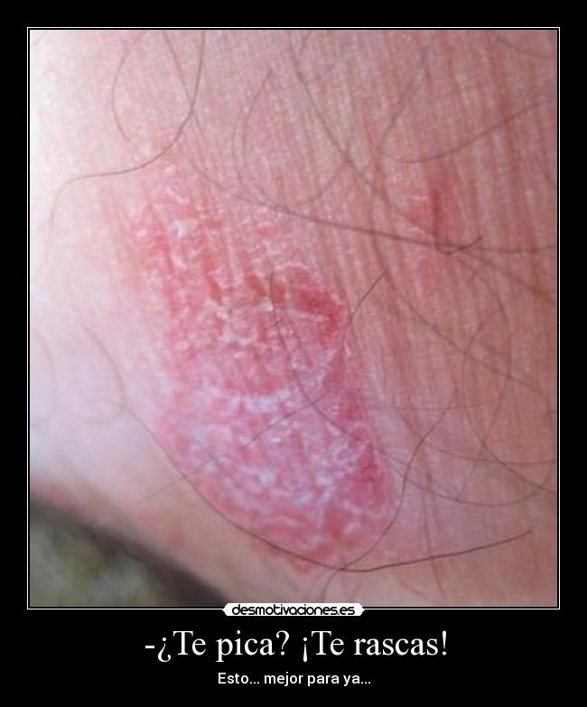 -¿Te pica? ¡Te rascas! - 