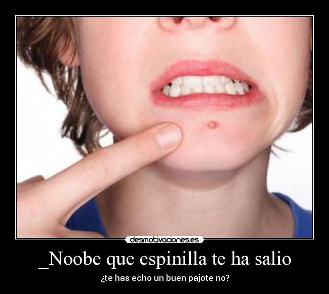 _Noobe que espinilla te ha salio -