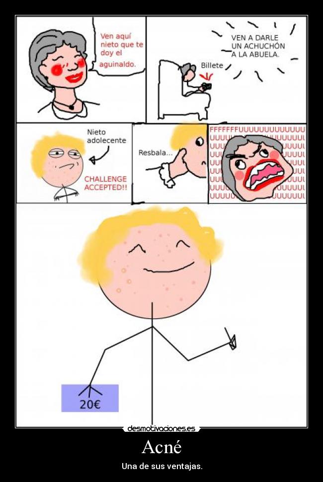 Acné - Una de sus ventajas.