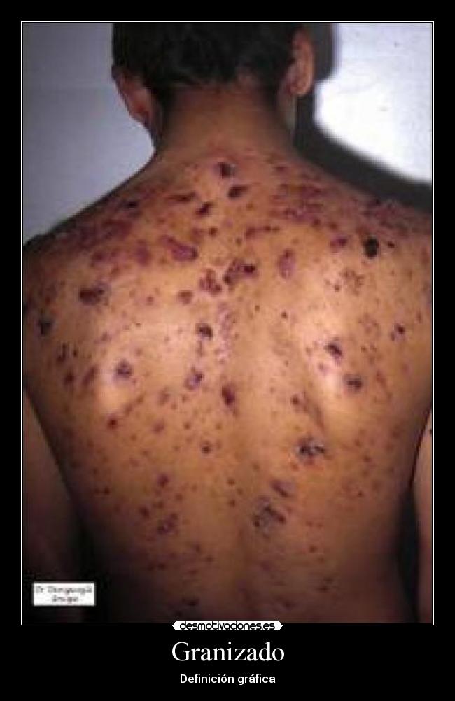 Granizado - Definición gráfica