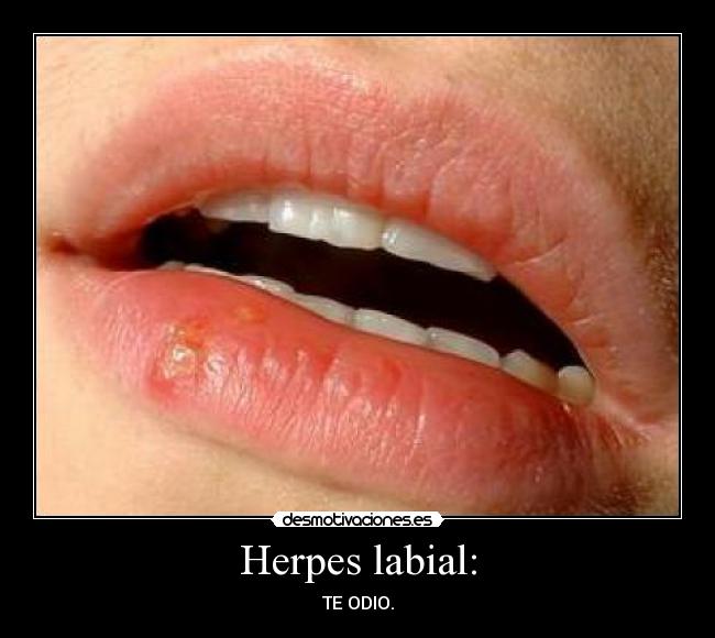 Herpes labial: - 