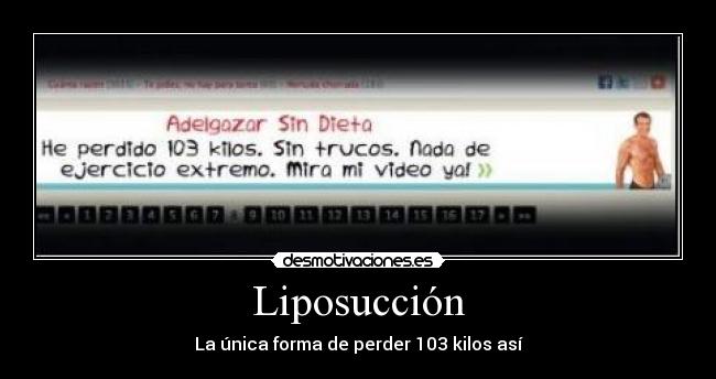 Liposucción - 