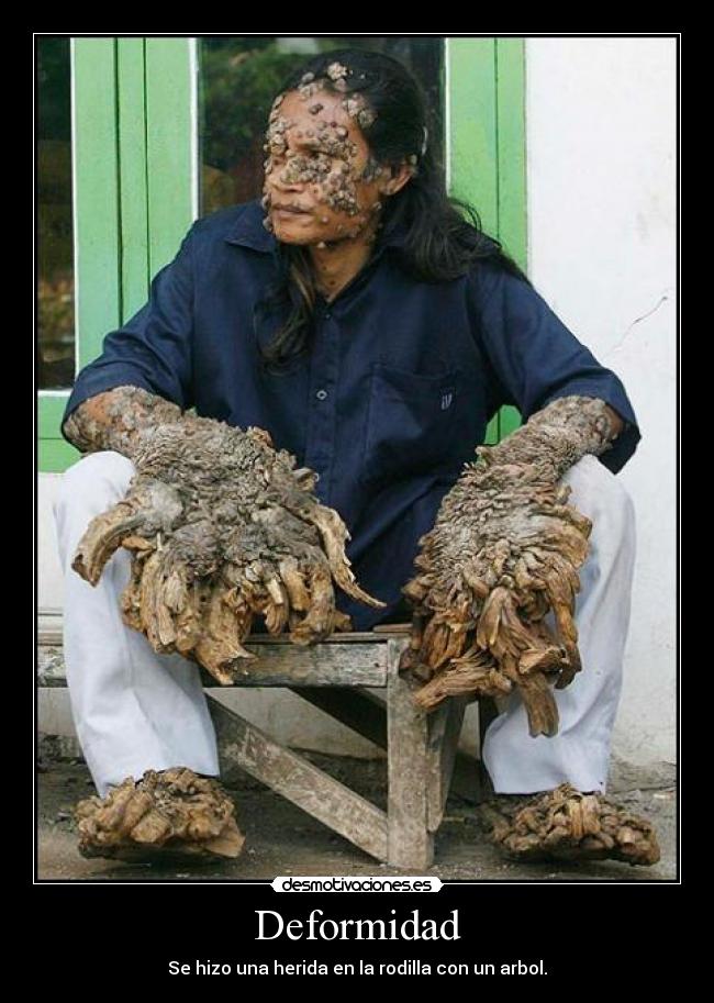 Deformidad - Se hizo una herida en la rodilla con un arbol.