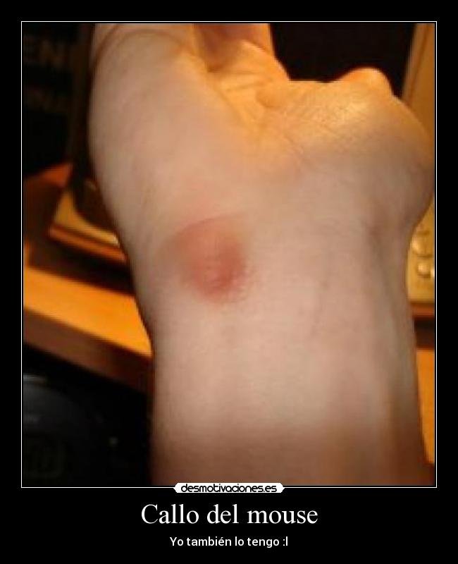 Callo del mouse - Yo también lo tengo :l