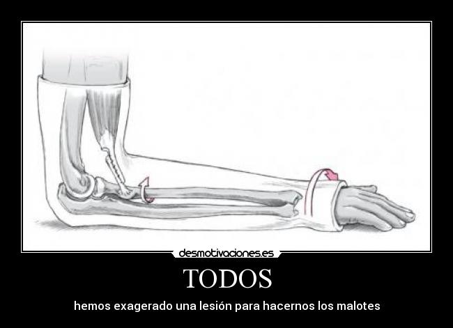 TODOS - hemos exagerado una lesión para hacernos los malotes