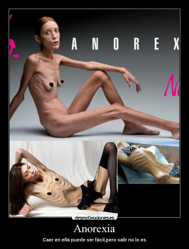Anorexia -