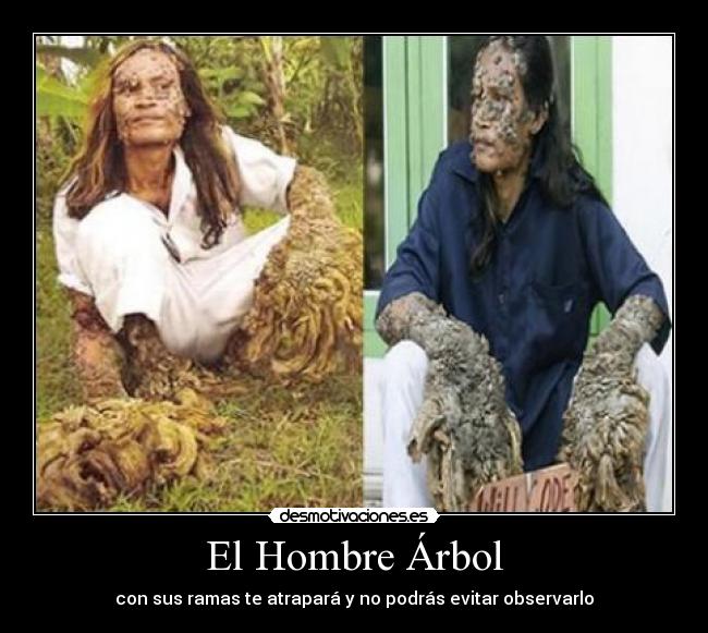 El Hombre Árbol -