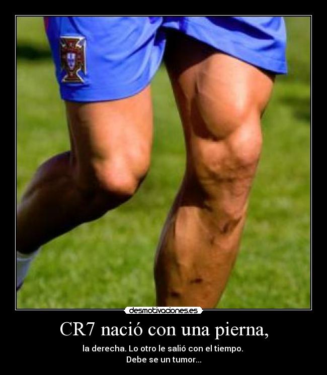 CR7 nació con una pierna, - la derecha. Lo otro le salió con el tiempo. 
Debe se un tumor...