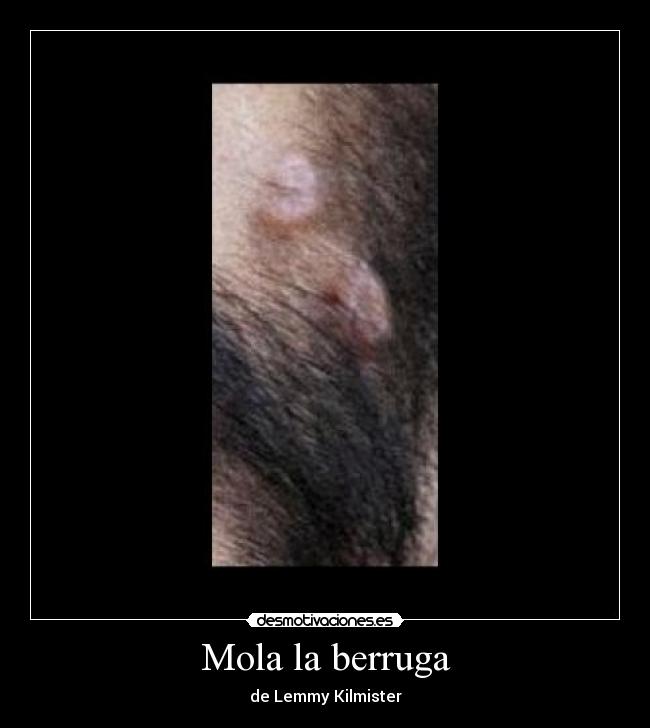 Mola la berruga -