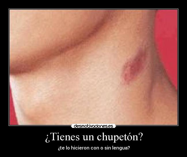 ¿Tienes un chupetón? - ¿te lo hicieron con o sin lengua?