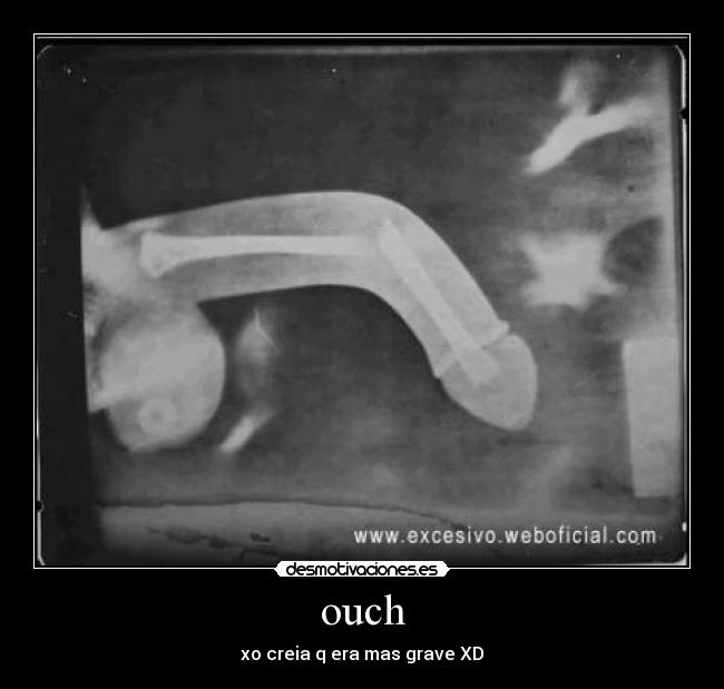 ouch - xo creia q era mas grave XD