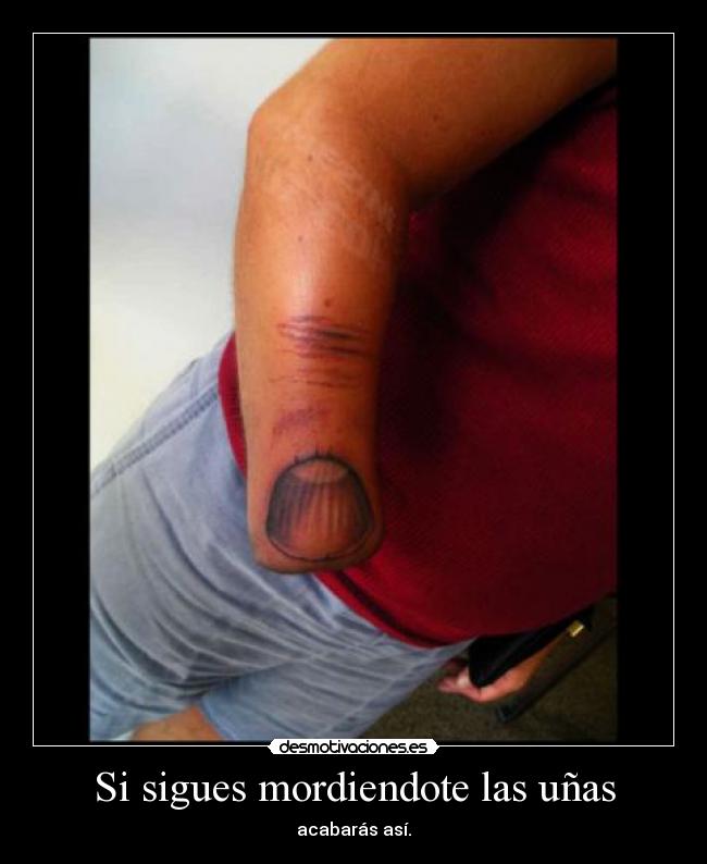 Si sigues mordiendote las uñas -