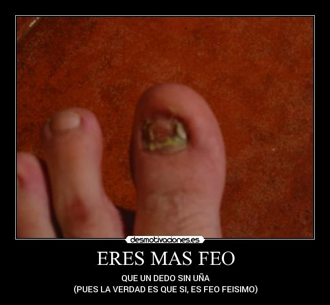 ERES MAS FEO - QUE UN DEDO SIN UÑA
(PUES LA VERDAD ES QUE SI, ES FEO FEISIMO)