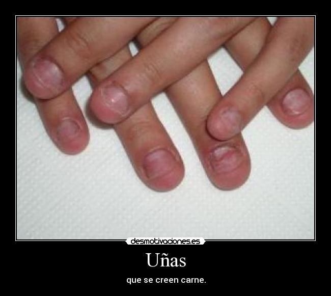 Uñas - que se creen carne.