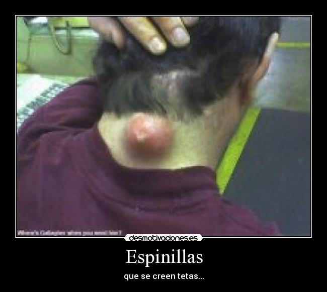 Espinillas - que se creen tetas...