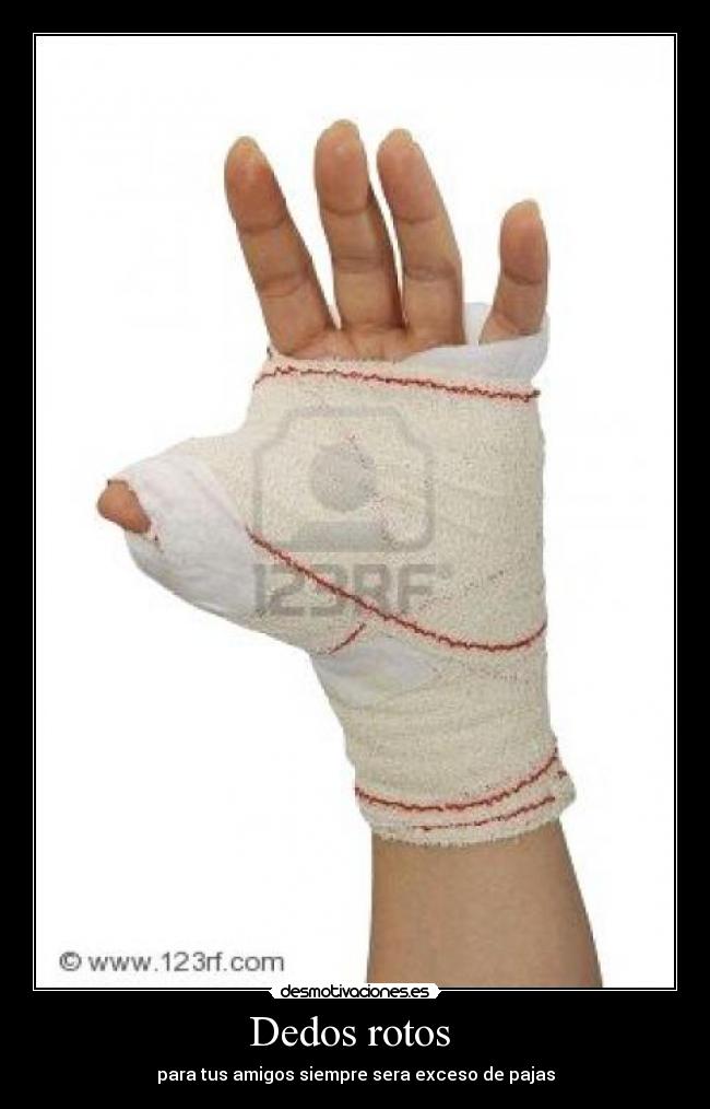 Dedos rotos -