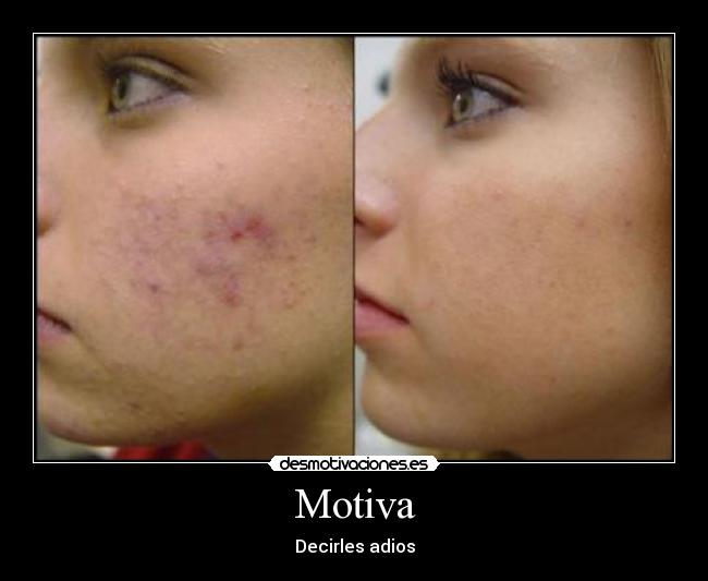 carteles acne desmotivaciones