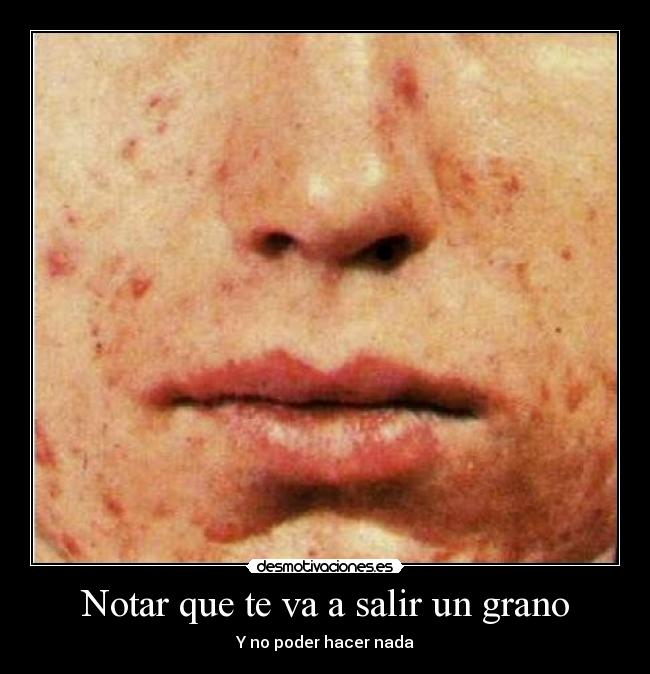 carteles acne desmotivaciones