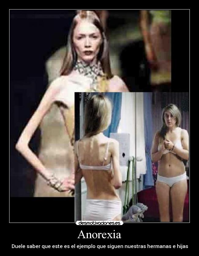 Anorexia - Duele saber que este es el ejemplo que siguen nuestras hermanas e hijas