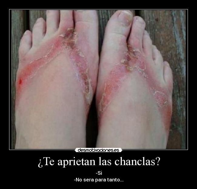 ¿Te aprietan las chanclas? -