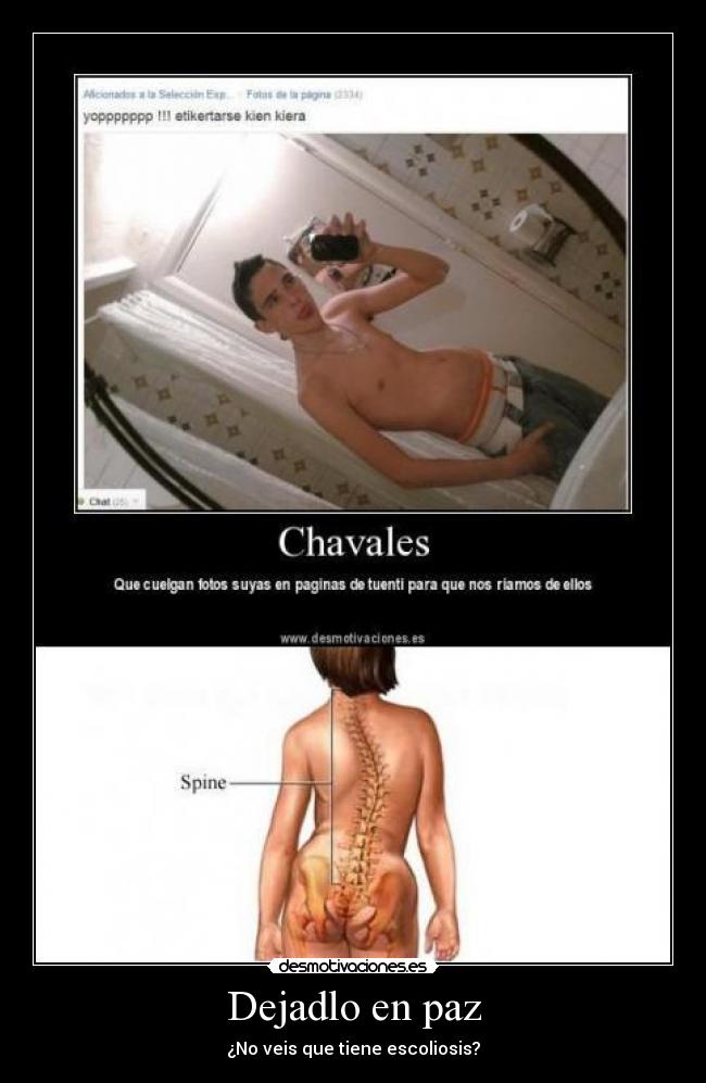 Dejadlo en paz - ¿No veis que tiene escoliosis?