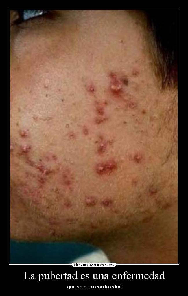 La pubertad es una enfermedad - que se cura con la edad