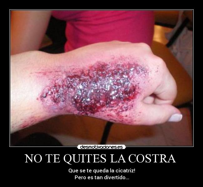 NO TE QUITES LA COSTRA - Que se te queda la cicatriz!
Pero es tan divertido...