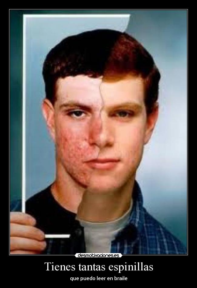 Tienes tantas espinillas - que puedo leer en braile