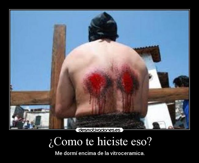 ¿Como te hiciste eso? - Me dormí encima de la vitroceramica.