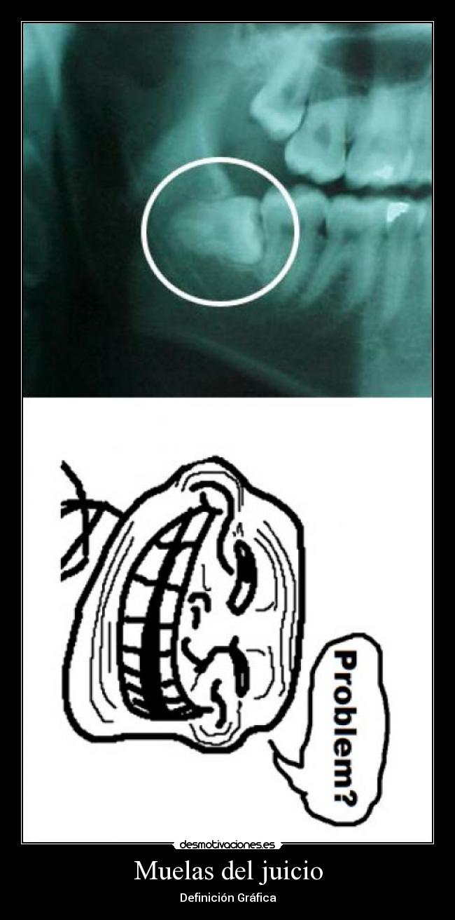 Muelas del juicio - 