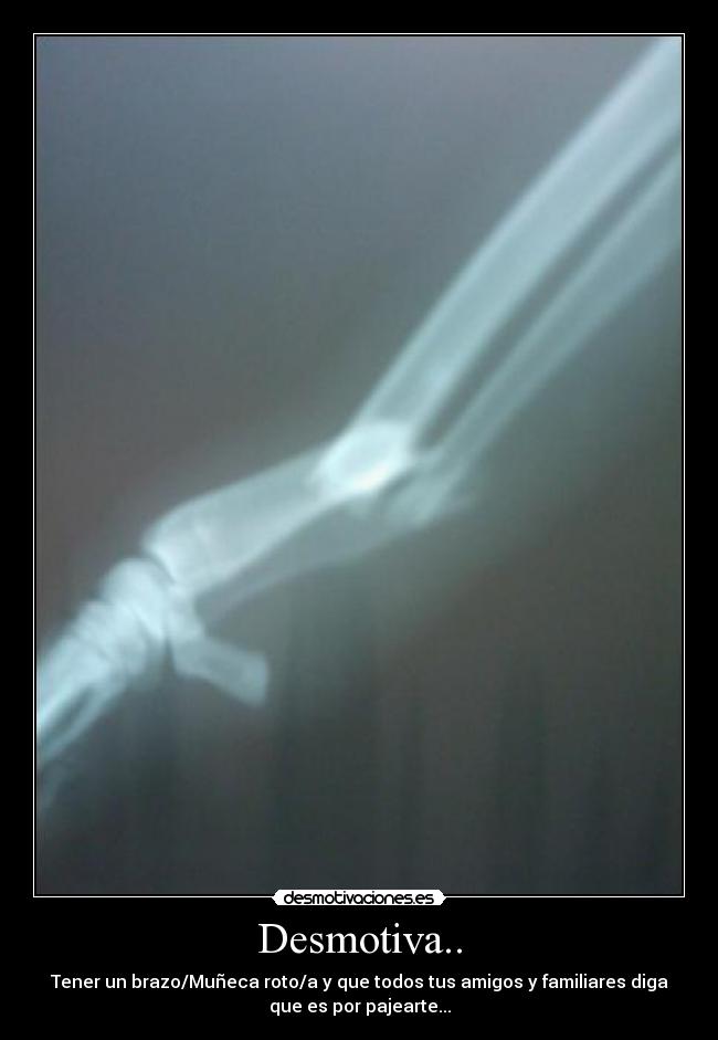 Desmotiva.. - Tener un brazo/Muñeca roto/a y que todos tus amigos y familiares diga
que es por pajearte...