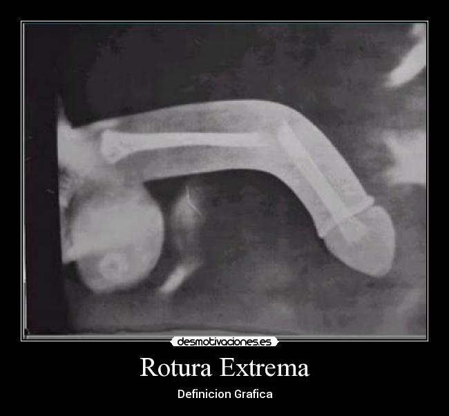 Rotura Extrema -