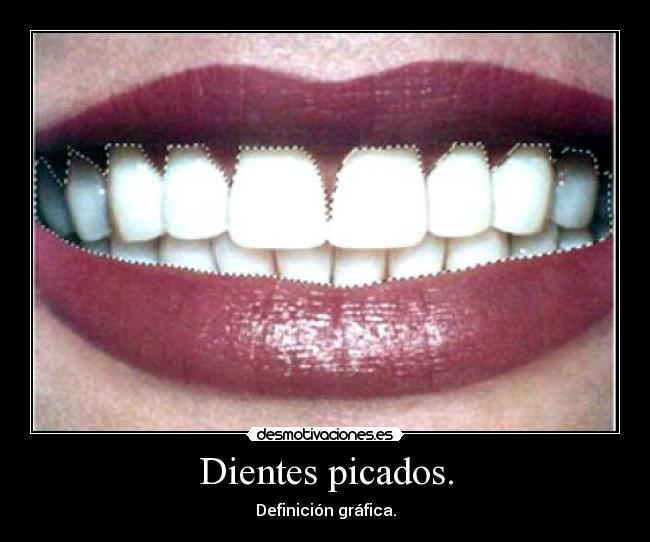 Dientes picados. - Definición gráfica.