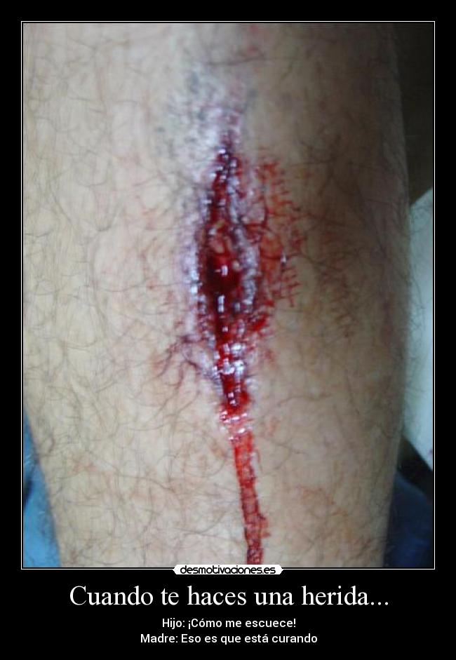 Cuando te haces una herida... - 
