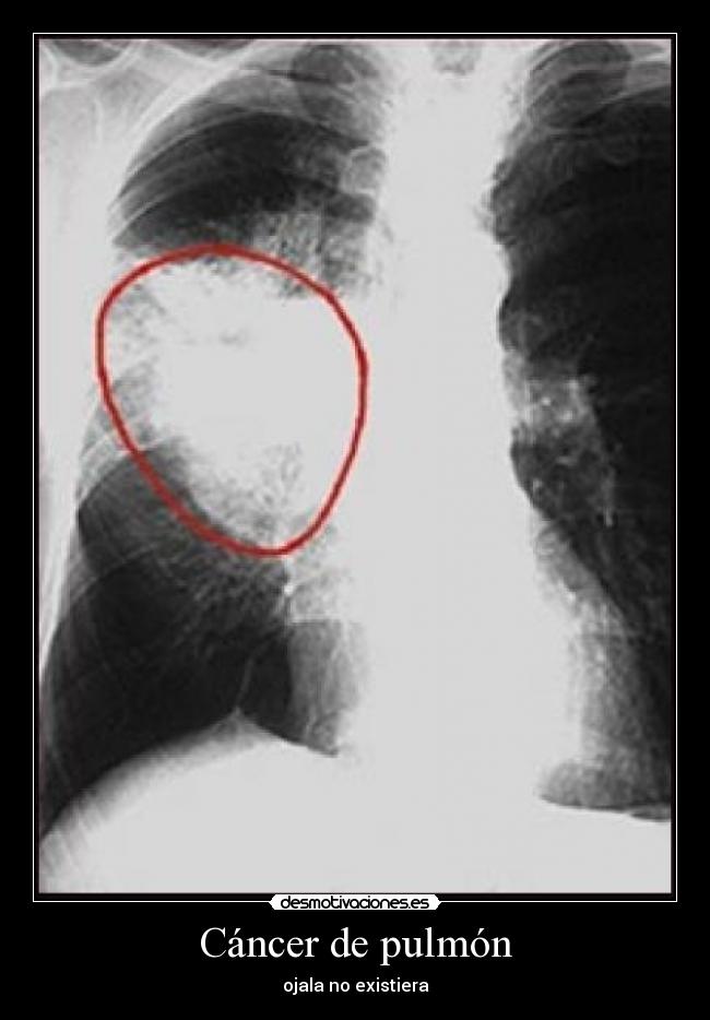 Cáncer de pulmón - ojala no existiera