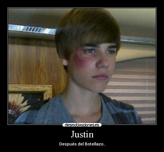 Justin - Después del Botellazo..