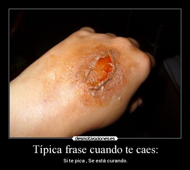Típica frase cuando te caes: - Si te pica , Se está curando.