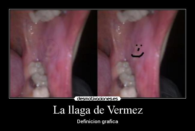 La llaga de Vermez - Definicion grafica
