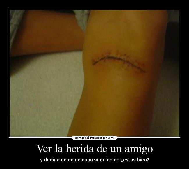 Ver la herida de un amigo - y decir algo como ostia seguido de ¿estas bien?