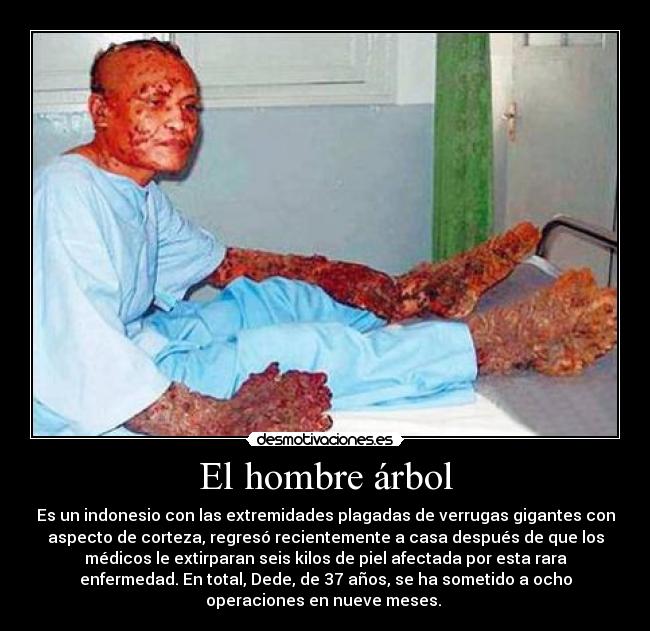 El hombre árbol - Es un indonesio con las extremidades plagadas de verrugas gigantes con
aspecto de corteza, regresó recientemente a casa después de que los
médicos le extirparan seis kilos de piel afectada por esta rara
enfermedad. En total, Dede, de 37 años, se ha sometido a ocho
operaciones en nueve meses. 