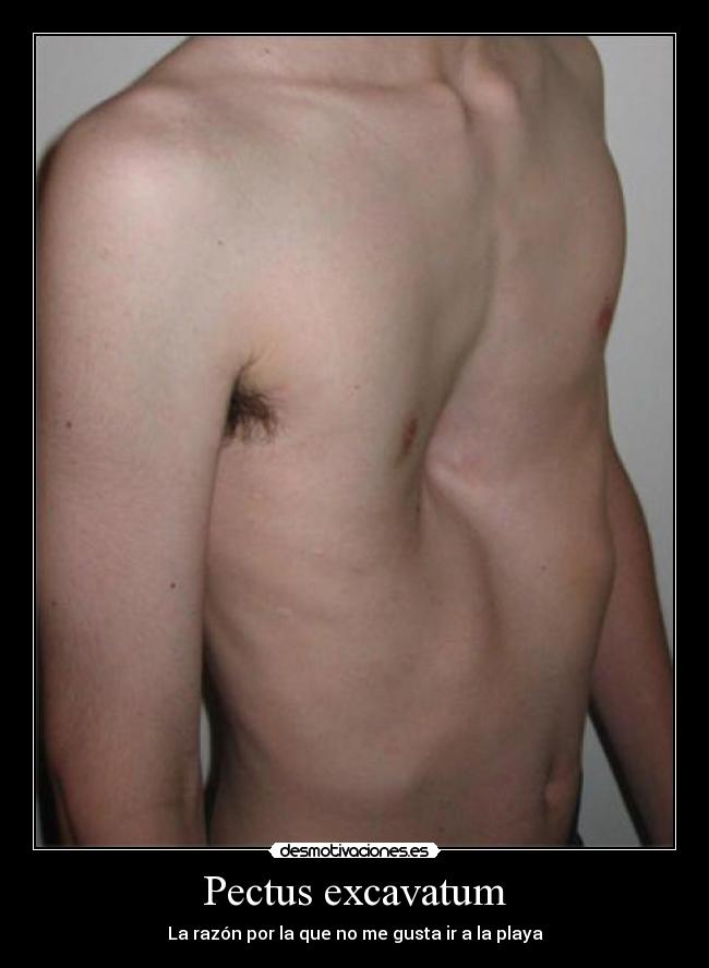 Pectus excavatum - 