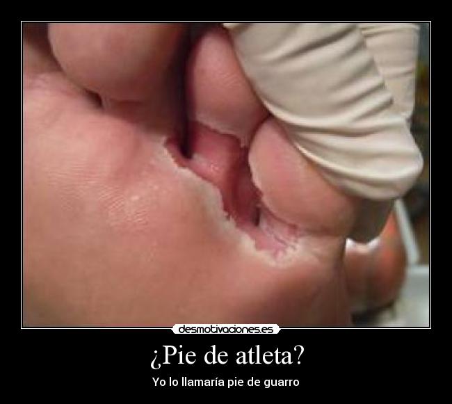 ¿Pie de atleta? - Yo lo llamaría pie de guarro