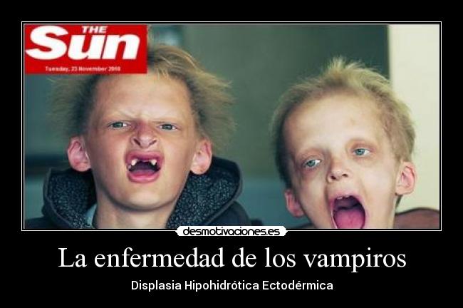 La enfermedad de los vampiros - Displasia Hipohidrótica Ectodérmica