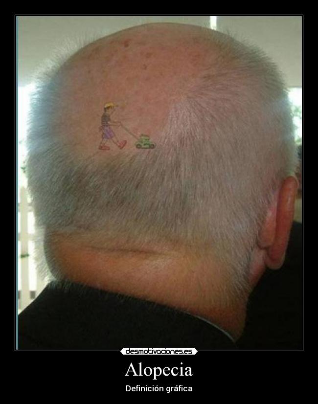 Alopecia - Definición gráfica