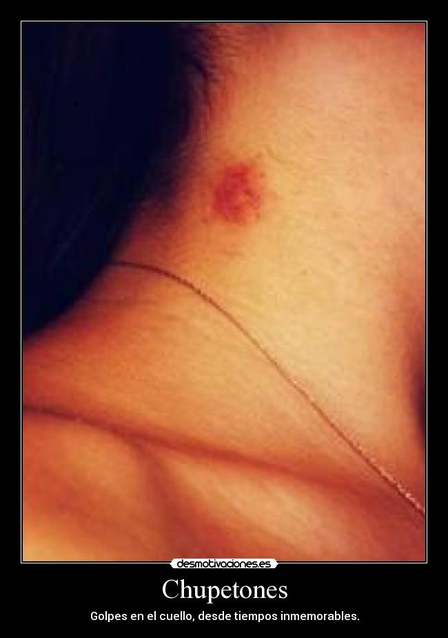 Chupetones - Golpes en el cuello, desde tiempos inmemorables.