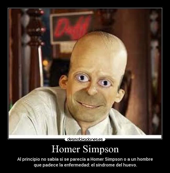 Homer Simpson - Al principio no sabía si se parecía a Homer Simpson o a un hombre
que padece la enfermedad: el síndrome del huevo.