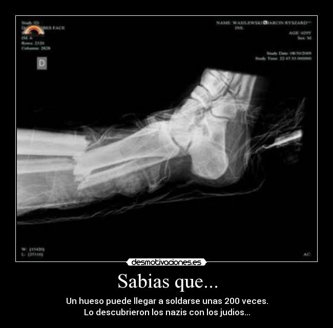 Sabias que... - Un hueso puede llegar a soldarse unas 200 veces.
Lo descubrieron los nazis con los judios...